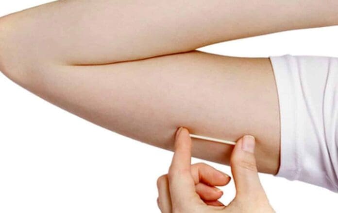 implante_contraceptivo